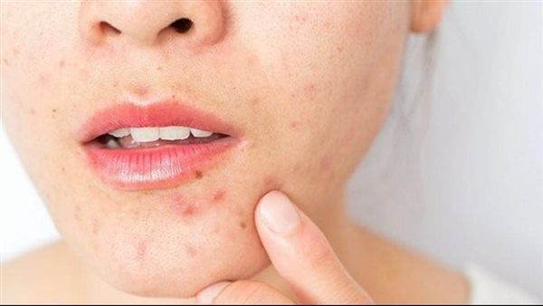 وصفة طبيعية لتقليل التهابات البشرة الدهنية