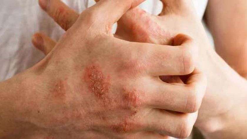 6 عادات شائعة تؤدي إلى الإصابة بالأكزيما.. منها استعمال الصابون