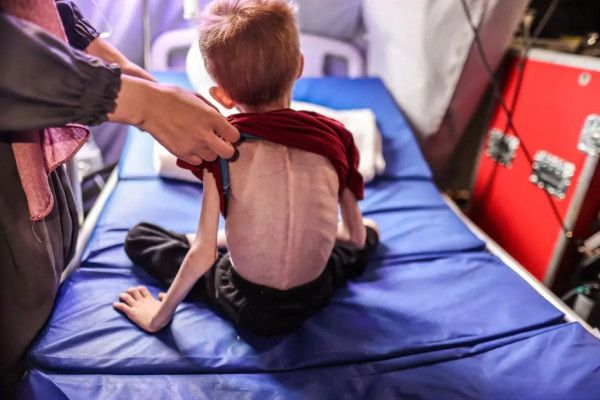 الصحة العالمية: أطفال غزة يموتون جوعاً وسط انهيار كامل للبنية الصحية