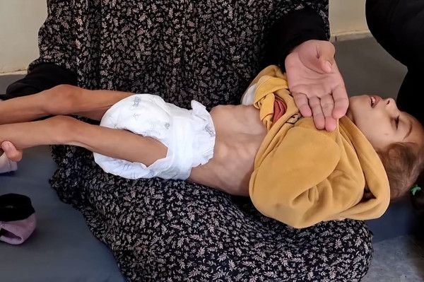 "الصحة العالمية": 112 طفلا يدخلون مستشفيات غزة يوميا بسبب سوء التغذية