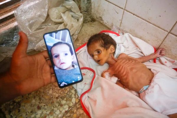 مدير مجمع الشفاء: سجلنا انتشار أوبئة تصعب مقاومتها لدى الأطفال بسبب سوء التغذية