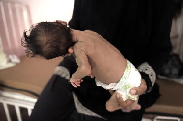 وفاة طفلة بسبب المجاعة وسوء التغذية في قطاع غزة
