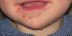 بعد تسببه في القلق داخل مدرسة بمصر.. كل ما تود معرفته عن فيروس HFMD وأعراضه وطرق الوقاية