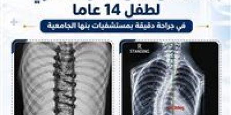 التعليم العالي: استعدال كامل للعمود الفقري لطفل 14 عامًا بمستشفيات جامعة بنها