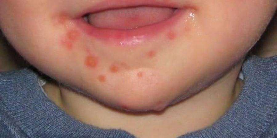 بعد تسببه في القلق داخل مدرسة بمصر.. كل ما تود معرفته عن فيروس HFMD وأعراضه وطرق الوقاية