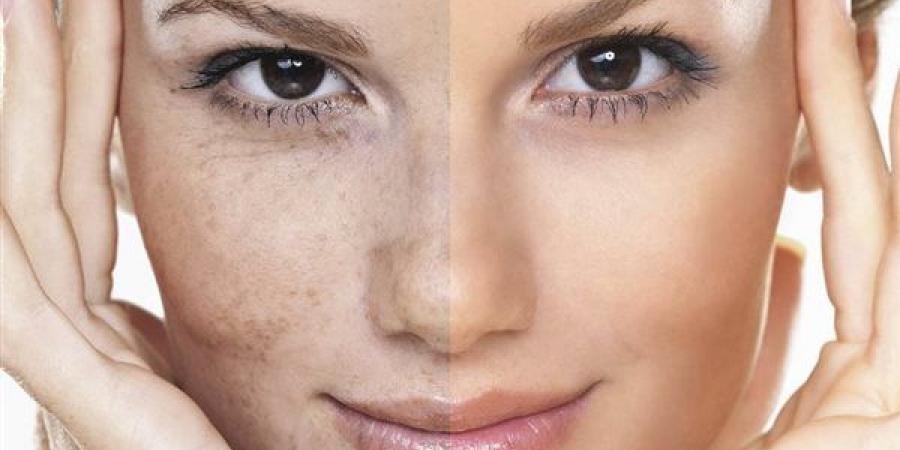 ماسكات طبيعية تساعد على تقليل تصبغات البشرة واستعادة صفائها