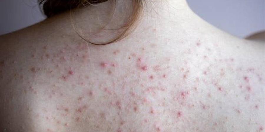 اصنعى بنفسك صابونة طبيعية لعلاج حبوب الظهر
