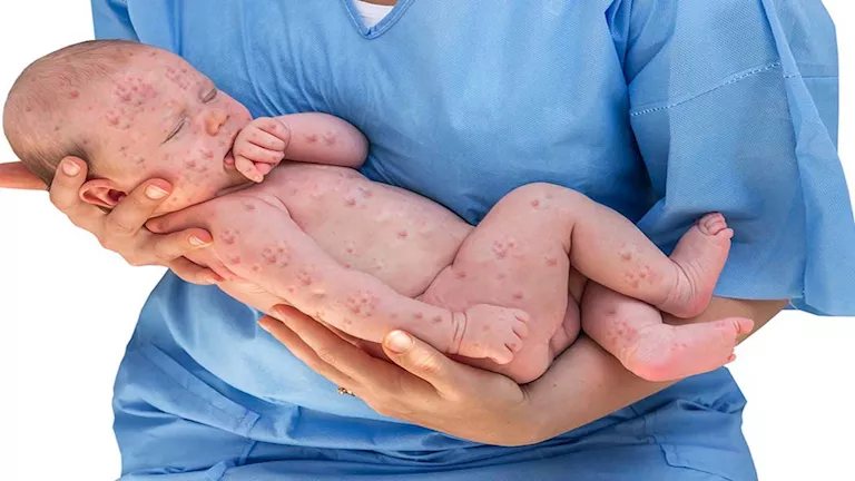 أستاذ طب وقائي: الحصبة الألمانية تهدد الأجنة خلال الأشهر الثلاثة الأولى من الحمل